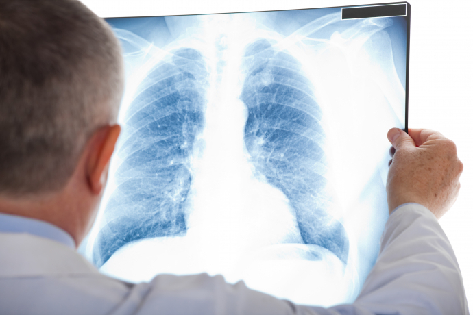Mężczyzna w białym kitlu trzyma w rękach rentgen klatki piersiowej i przykłada go do podświetlacza. 